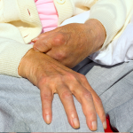 Do you care for a stroke patient? Tell us about your experiences